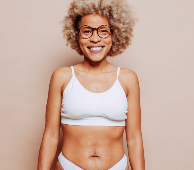 How to Feel Confident in a Bikini with Stretch Marks